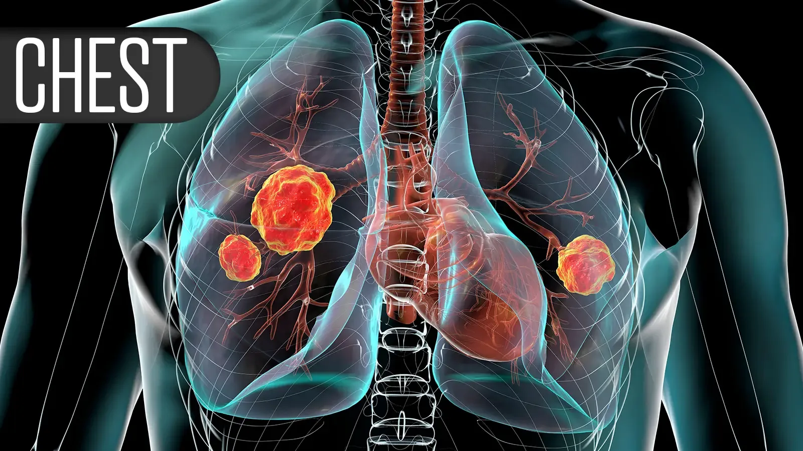 Hypoglossal Nerve Stimulation: A New Hope for Sleep Apnea Relief