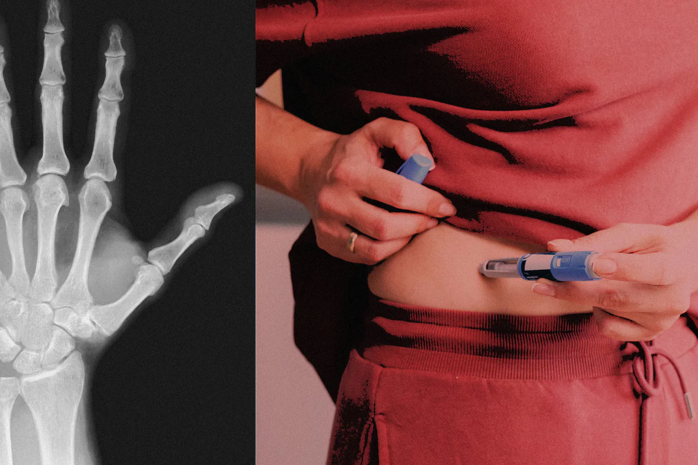 GLP-1 Drugs Like Ozempic Raise Bone and Tendon Injury Risks, Study Suggests