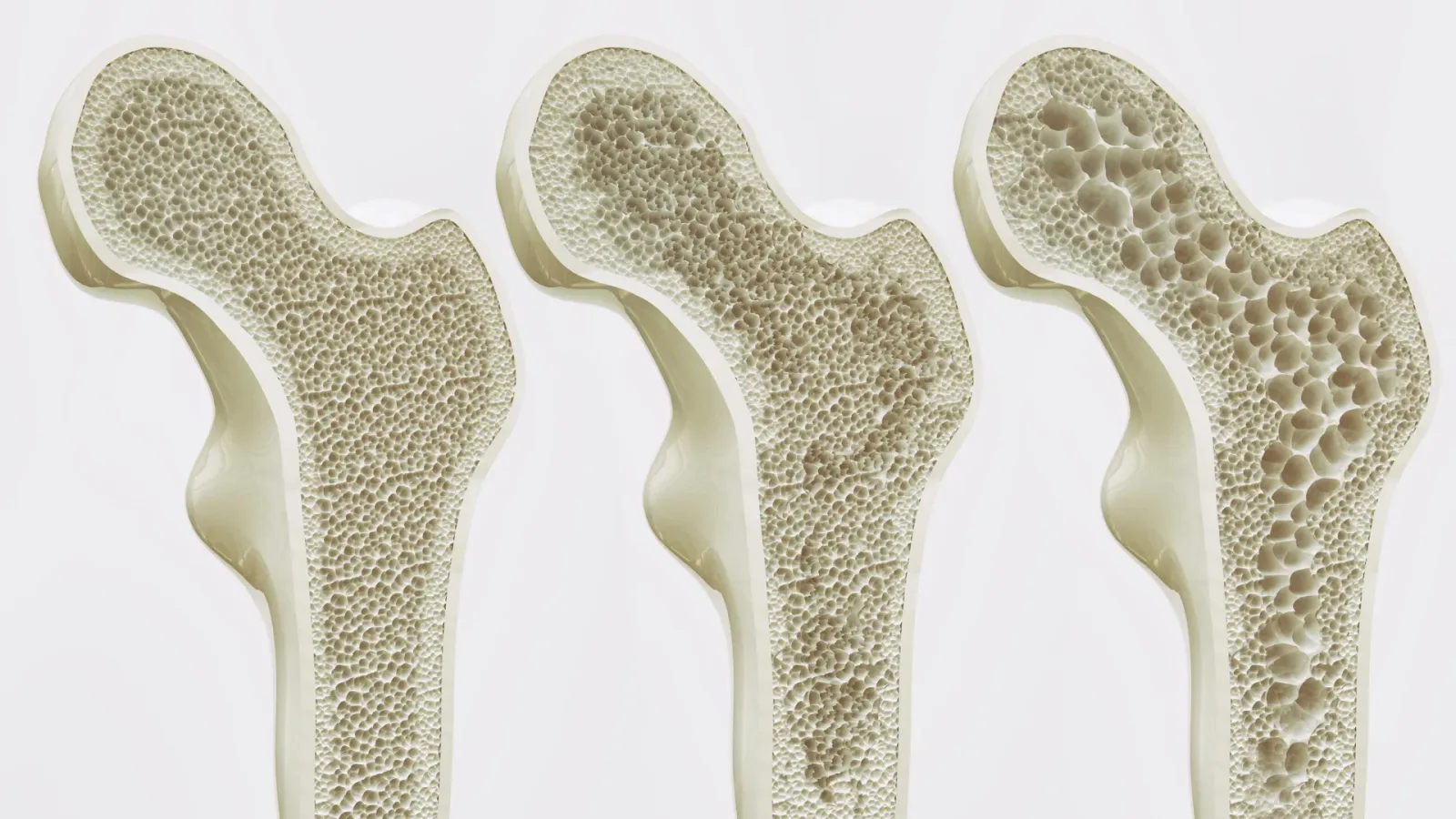 Semaglutide Linked to Fewer Bone Fractures Despite Greater Weight Loss