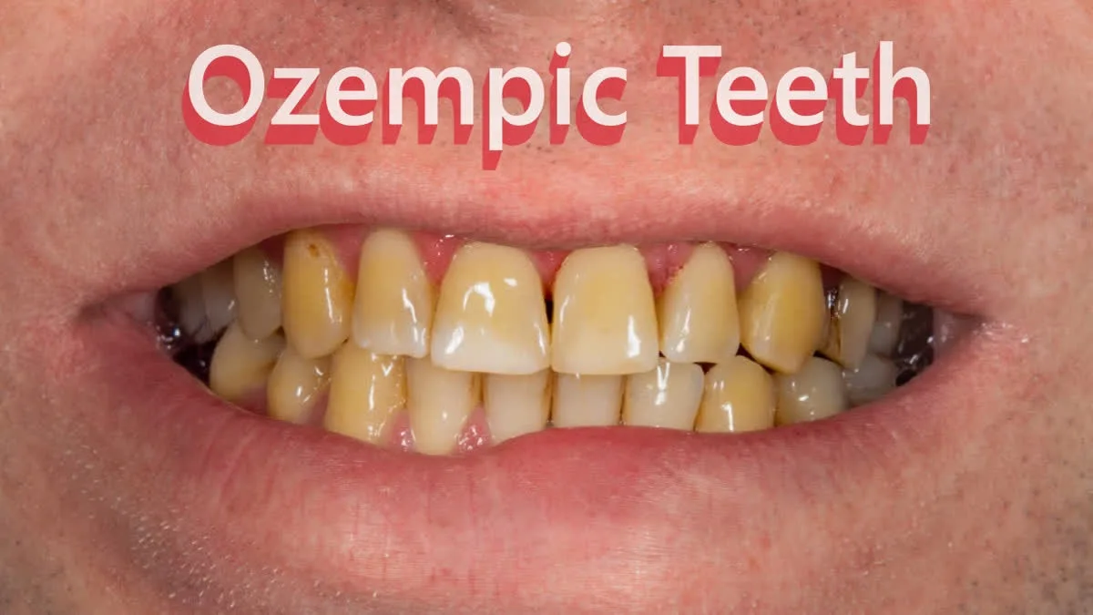 'Ozempic Teeth': Dentists Urge Awareness of Weight Loss Drug Oral Risks