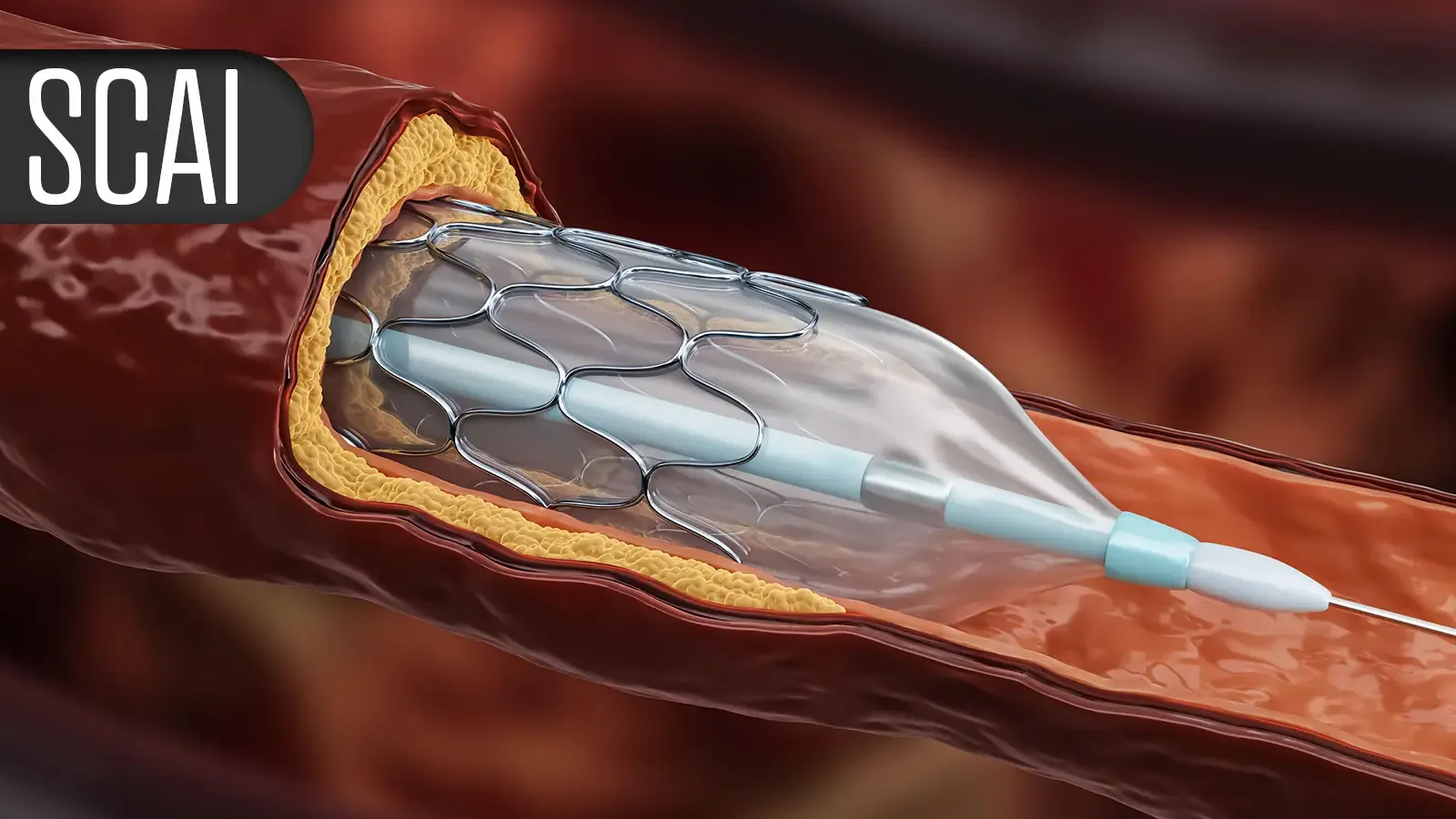 Medicamentos GLP-1: Nova Promessa em Procedimentos Cardiovasculares