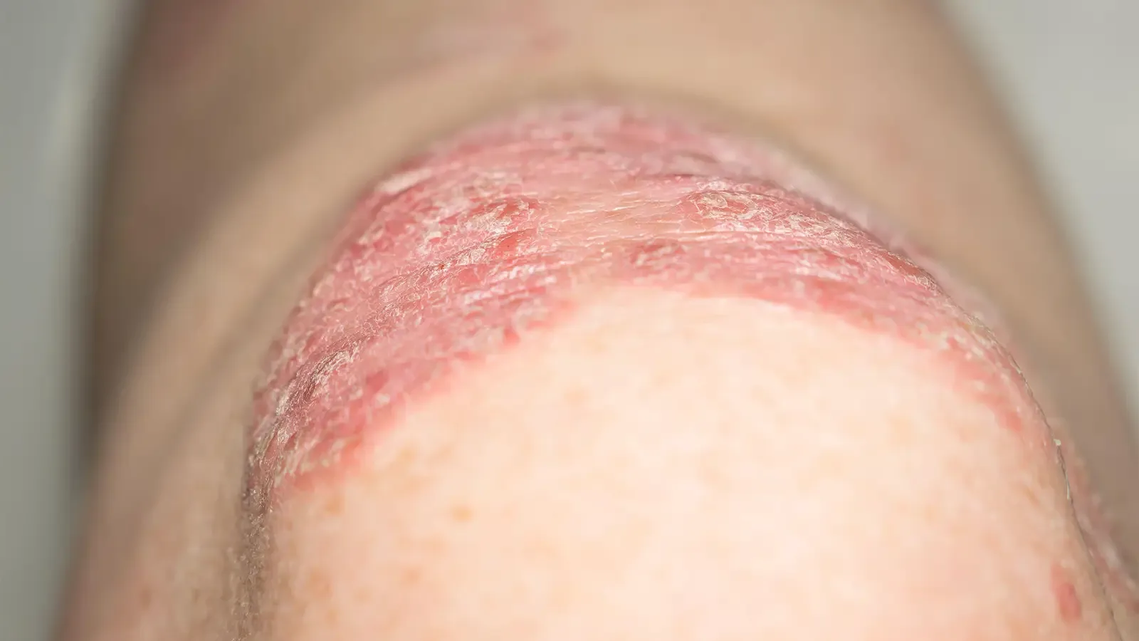 GLP-1-Agonisten bei Psoriasis: Neue Hoffnung für Gewicht & Entzündung