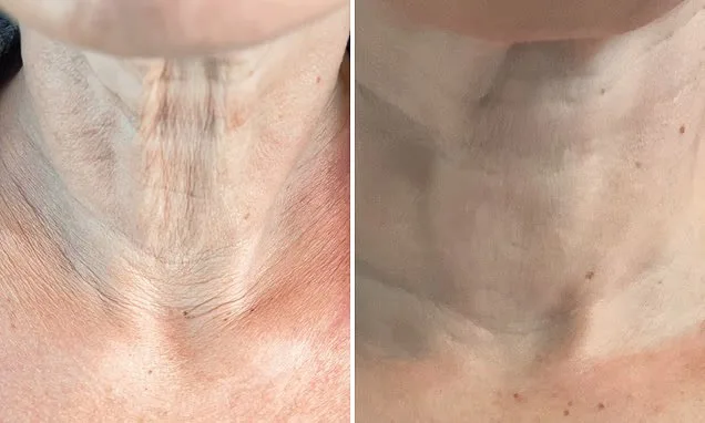 Fixing Saggy Skin & Thin Hair After 10kg Ozempic Loss