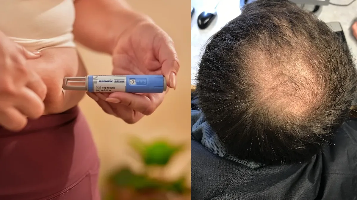 Menggunakan Ozempic atau Wegovy? Dokter Kulit Peringatkan Insiden 'Ozempic Hair' yang Meningkat